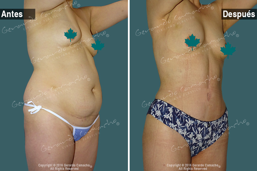 Procedimiento de abdominoplastia para tonificar abdomen en Bogotá